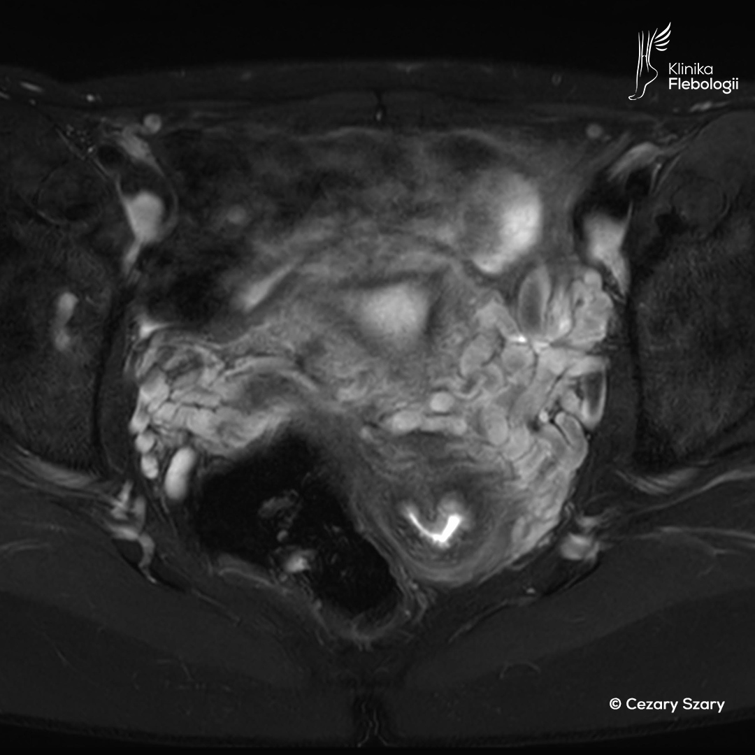 Wenografia MR. Żylaki przymacicz. Cezary Szary