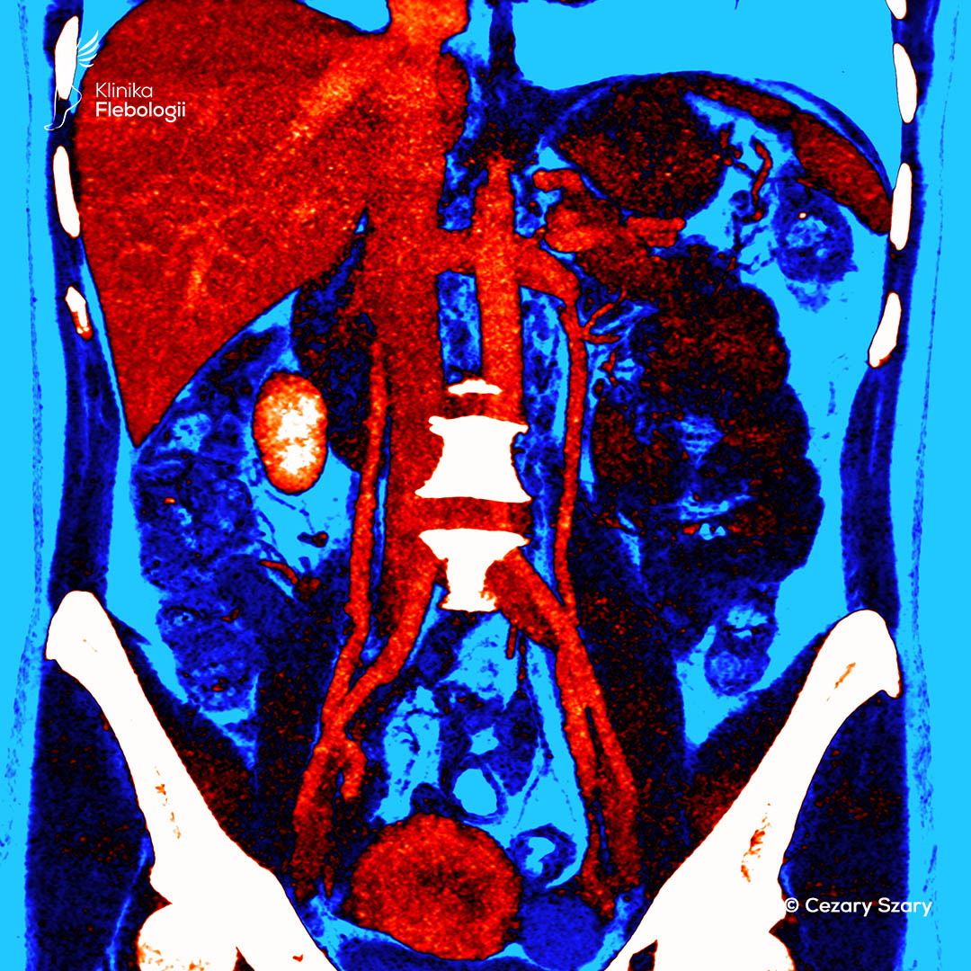 Poszerzenie żył jajnikowych. Wenografia TK. Cezary Szary