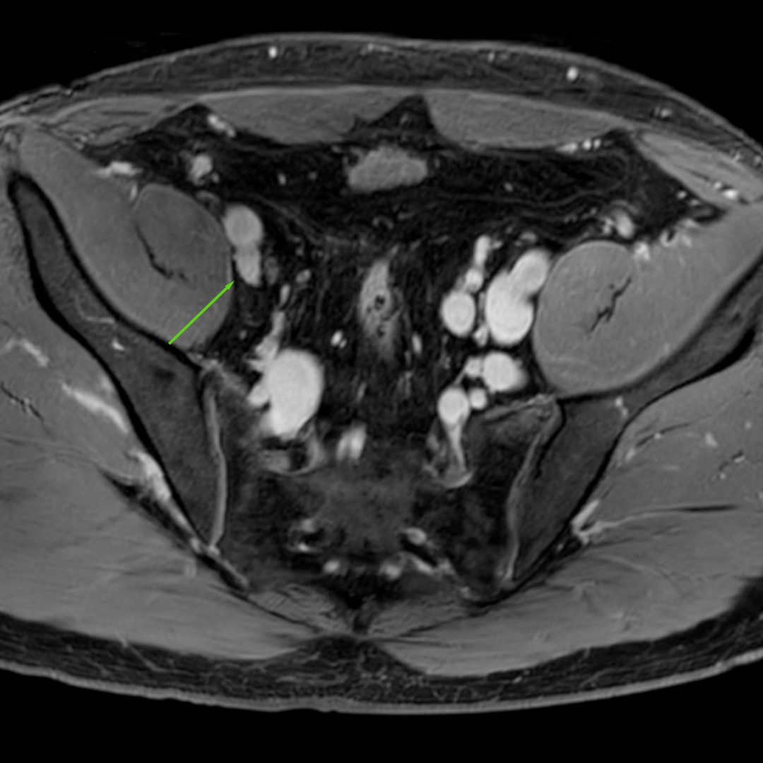 Pozakrzepowa żyła biodrowa.