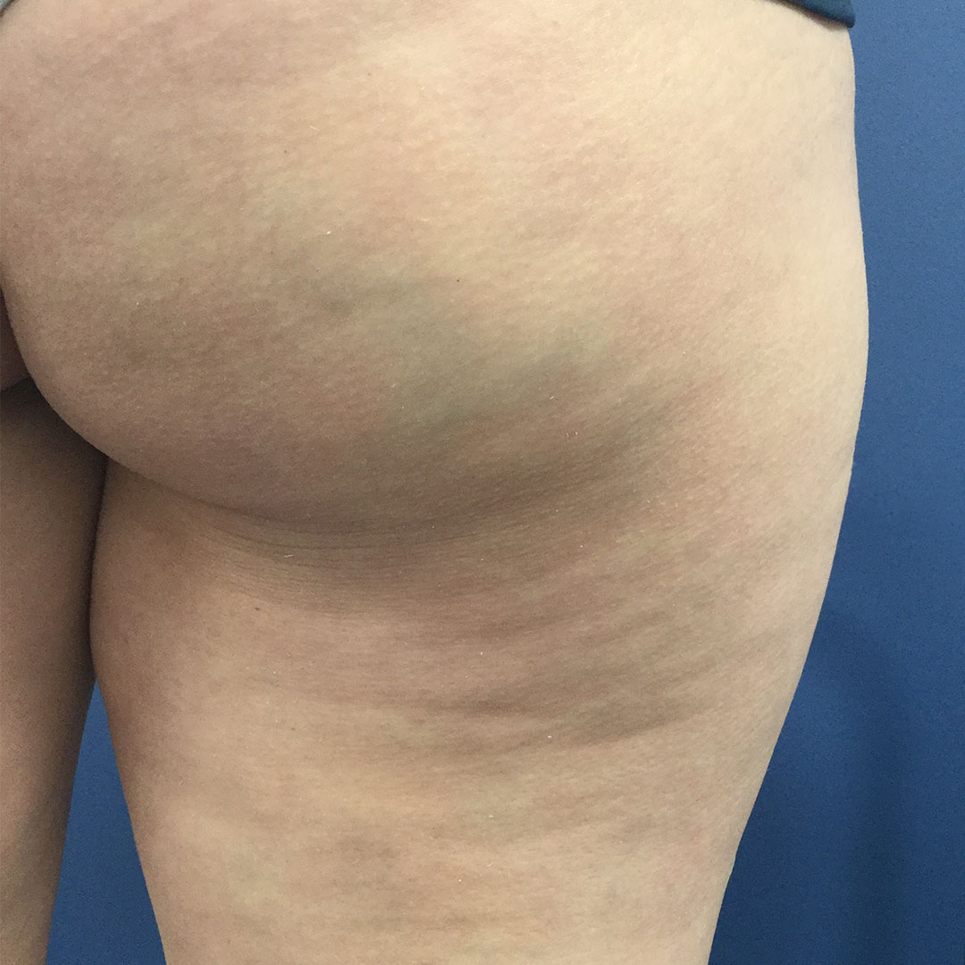 Żylak spływu żyły pośladkowej dolnej.