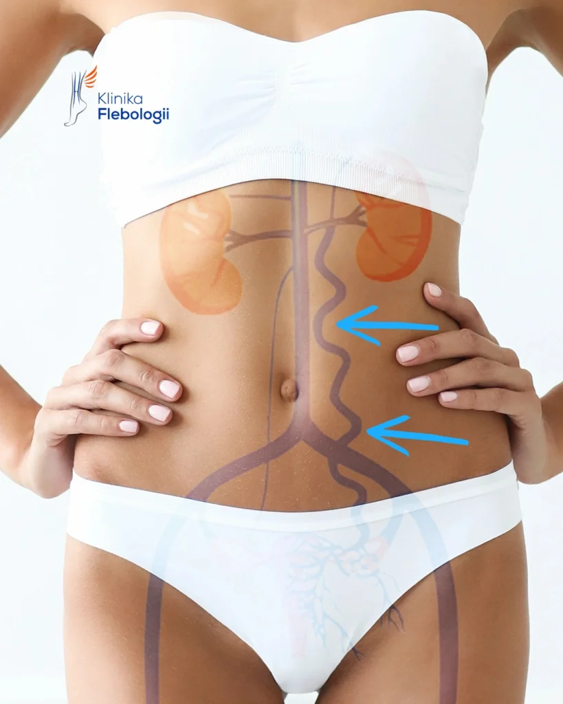 Zdjęcie przedstawiające przebieg anatomiczny spływu lewej żyły jajnikowej. 