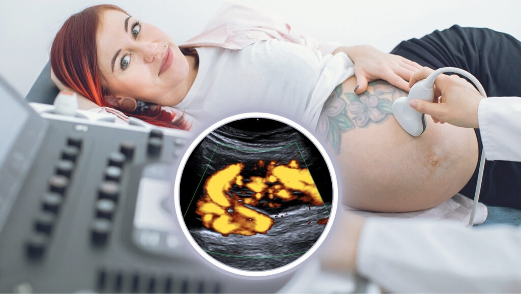 Kobieta w ciąży w gabinecie flebologicznym. Wykonywane jest badanie USG Doppler żył miednicy. 