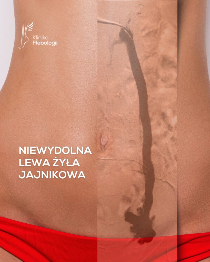 Niewydolność lewej żyły jajnikowej we flebografii cyfrowej.