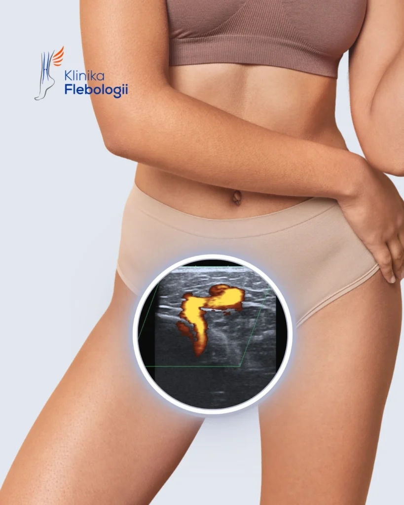 Młoda kobieta z przeciekiem żylnym tylnej części krocza. Obraz w USG Doppler.