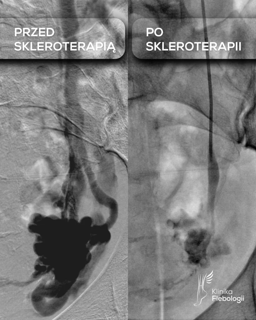 Spływ lewej żyły jajnikowej (LOV) po podaniu sklerozantu w obręb splotów żylnych przymacicz. Klinika Flebologii