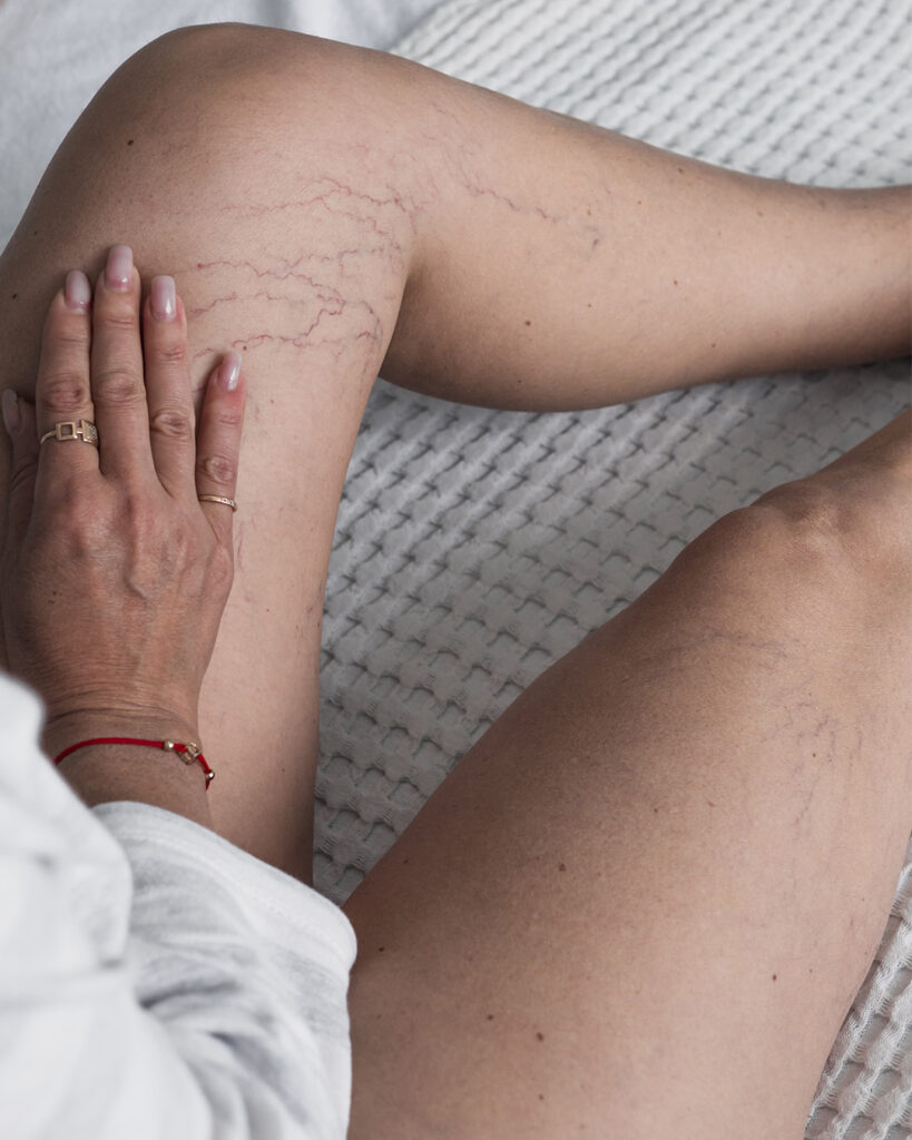 Kobieta z pajączkami naczyniowymi na nogach.